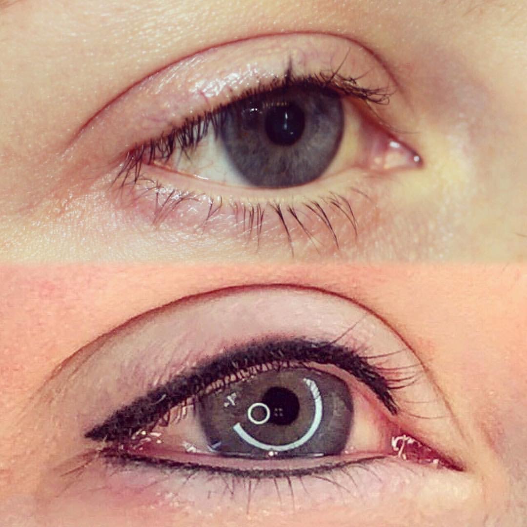 Permanent Eyes before and after image
