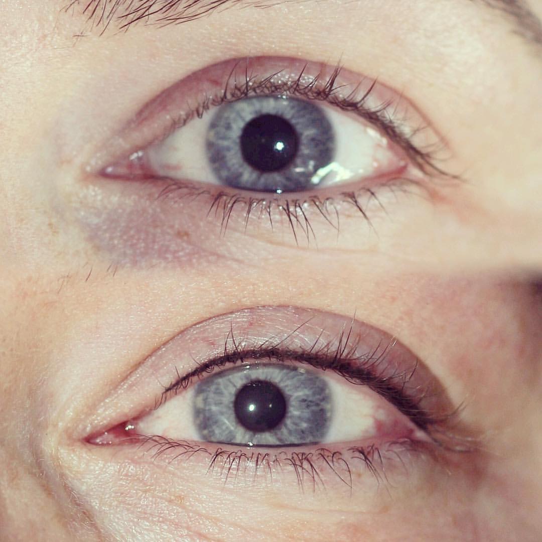 Permanent Eyes before and after image